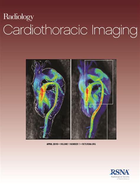 Going beyond Cardiomegaly: Evaluation of Cardiac Chamber.